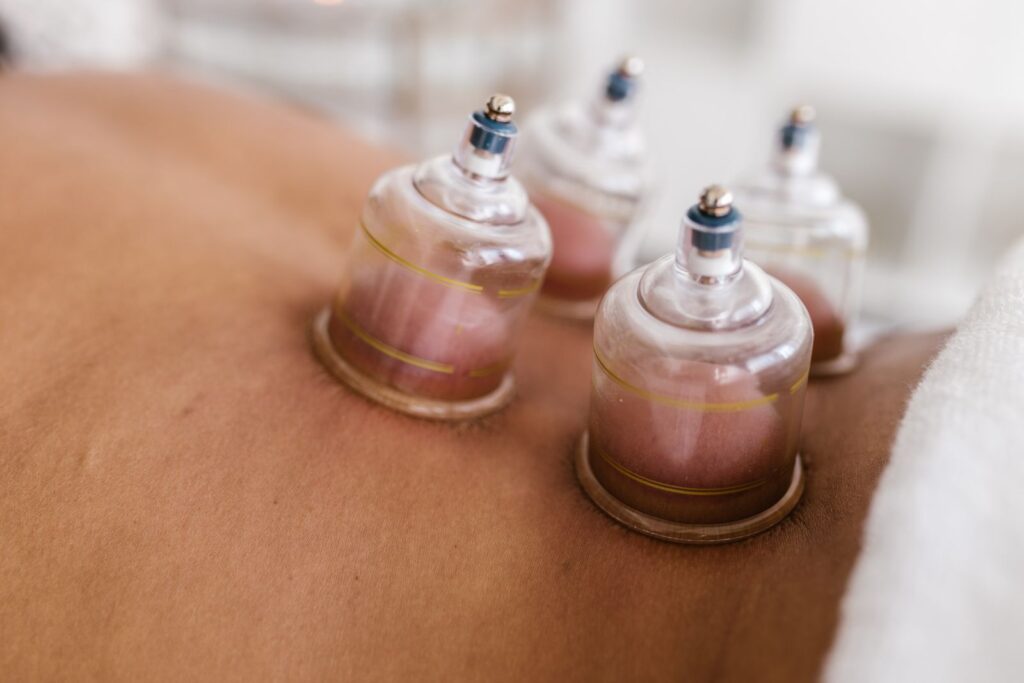 Cupping terapi med glaskopper på ryggen